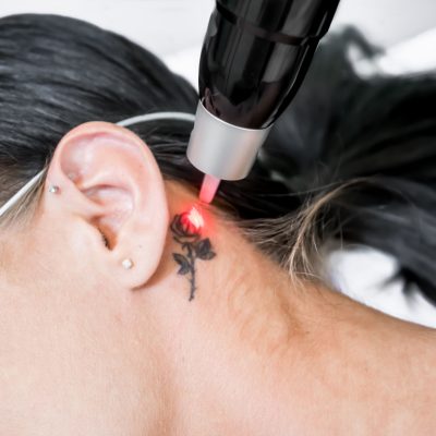 Laser tattoo removal treatment session on patient, using picosecond technology, to break down tattoo ink into smaller particles. At a beauty and skincare clinic for aesthetic lasers.